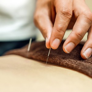 Acupuncture being performed 