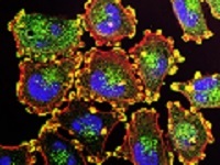 Image of metastatic melanoma cells