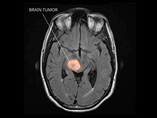 Brain tumor