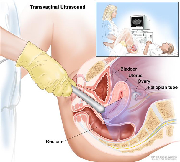 endometrial-cancer-bleeding-common-symptom
