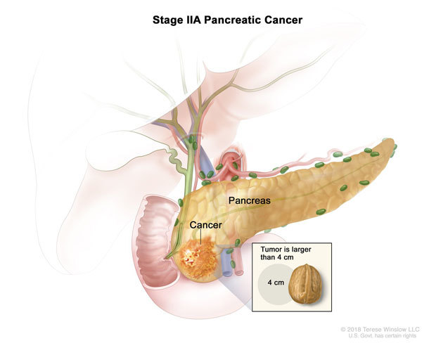 pancreatic-cancer-chemotherapy-regimen-change