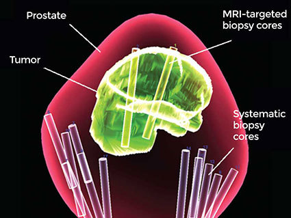 A 3-d map of the prostate using combined MRI-targeted and systematic biopsies. 