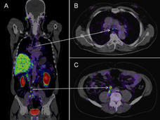 detecting-metastases-in-localized-prostate-cancer