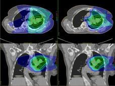 proton-vs-imrt-lung-cancer