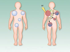 Immune-mediated-abscopal-effects