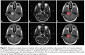 Vestibular-Schwannoma-SEG