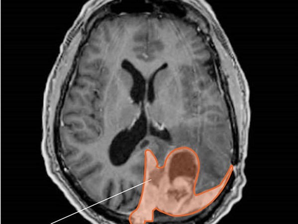 scan of brain tumor