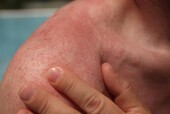 Sun damaged skin