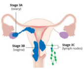 Endometrial cancer stage 3