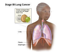 Stage 1B Lung Cancer