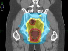 IMRT rectal scan