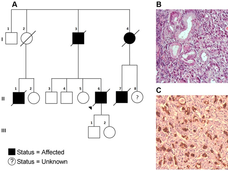 A family pedigree showing a germline mutation associated with familial gastric cancer and pathology images of gastric tumor cells.