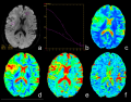 Imaging of low-grade glioma