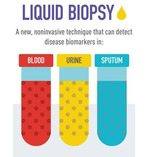 Liquid Biopsy: A new, noninvasive technique that can detect diseae biomarkers in blood, urine, and sputum.