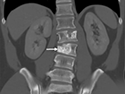 A CT scan of a person with alveolar soft part sarcoma that has spread to the spine (arrow)