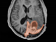 brain scan image showing meningioma