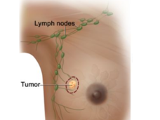 drawing of a breast and underarm lymph nodes with a small tumor