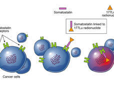 Lu 177-dotatate binds to somatostatin receptors on neuroendocrine tumor cells and kills the cells through the release of radioactive particles.