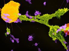 An electronic microscope image of a neutrophil (yellow) that has ejected a NET (green) that has captured bacteria (purple). 
