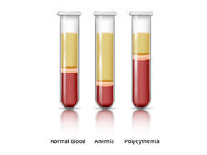 3 test tubes, 1 shows the normal amount of red blood cells, 1 with anemia shows fewer,  1 with polycythemia vera shows more