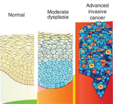 An illustration showing cancer progression from normal to mild dysplasia to advanced invasive cancer.