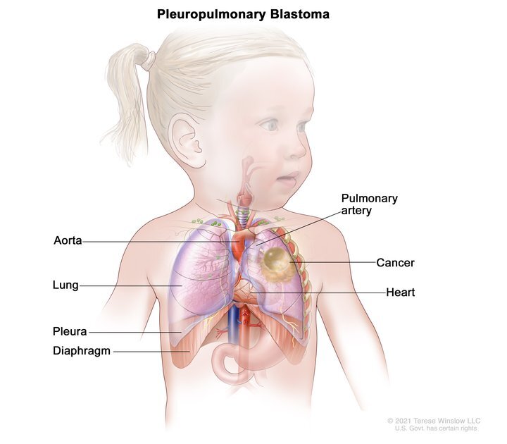 anatomy of small child showing tumor in her lung