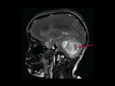 An MRI scan of a child with a low-grade glioma near the cerebellum.