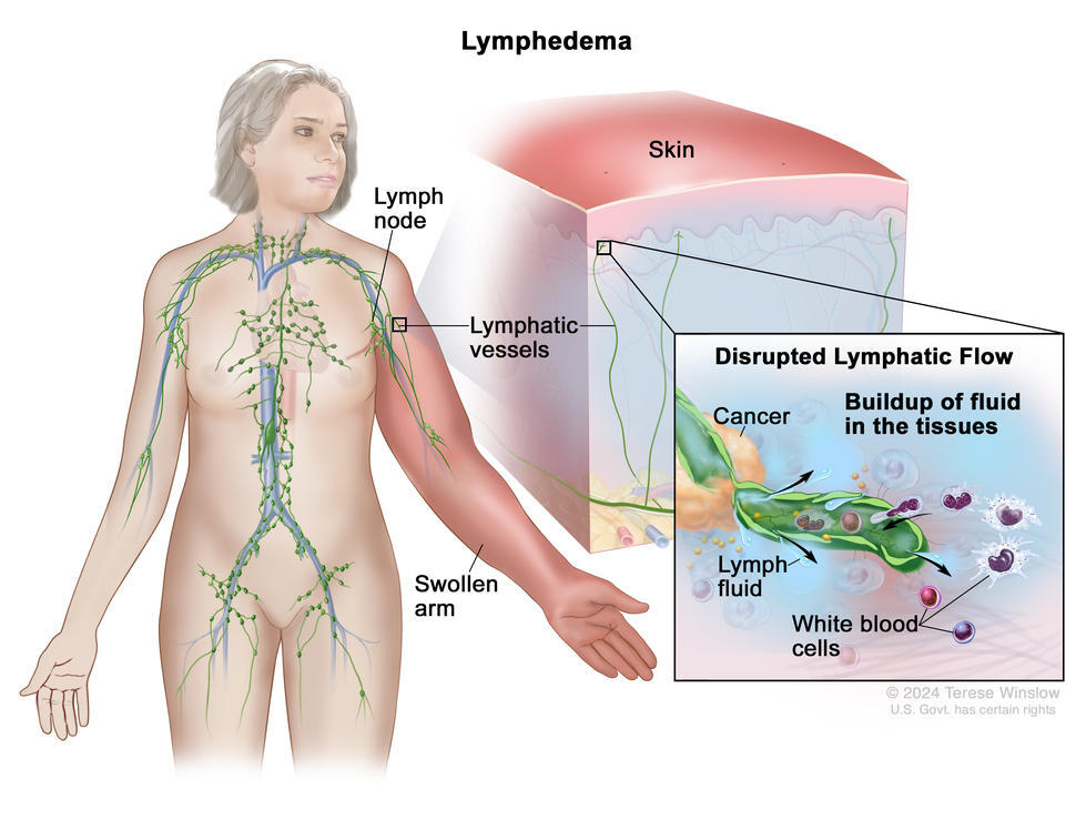 anatomical illustration of the lymphatic system show how lymph vessels are found throughout the body