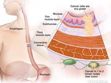 anatomical drawing of stage 2b esophageal cancer