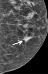 Abnormal mammogram results. 