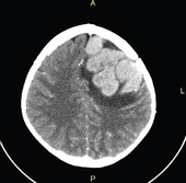 A CT scan of a tumor recurrence in the brain of a child with ALL. Credit: J Pediatr Neurosci. Sep-Dec 2012.