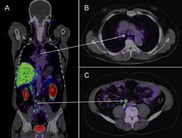 Prostate cancer shown with tumors in lymph nodes in the chest and abdomen. Credit: Adapted from Int J Mol Sci. July 2013