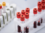 A rack of test tubes containing blood specimens.