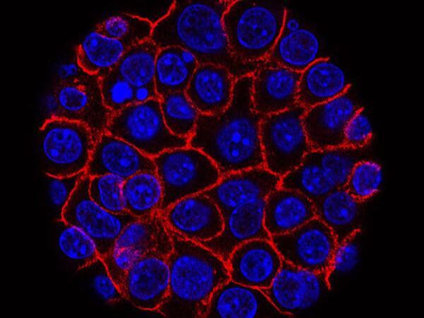 pancreatic cancer cells as seen under a microscope