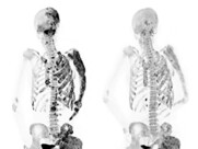photo of human skeleton