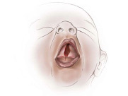 drawing of baby's mouth with cleft palate