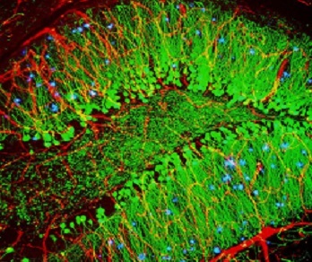 Mouse amyloid plaque image