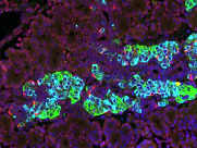 image of pancreatitis cells