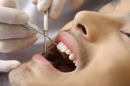 A patient with his mouth opened during oral checkup.