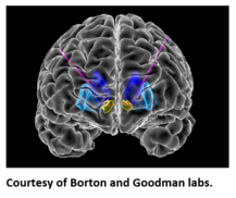 Deep brain stimulation therapy for OCD