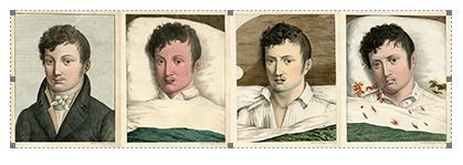 Four illustrations showing the progress of yellow fever in Observations sur la fièvre jaune, faites à Cadix, en 1819