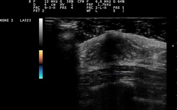 reast ultrasound