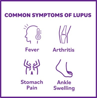 Common Symptoms of Lupus: Fever, Arthritis, Stomach Pain, and Ankle Swelling 