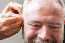 man receiving acupuncture in his outer ear