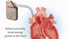 Graphic of human heart with energy device