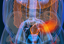 Illustration of colon showing colorectal cancer.