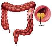 Colonoscopy and colorectal cancer