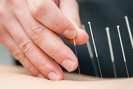 acupuncture needles in a persons leg