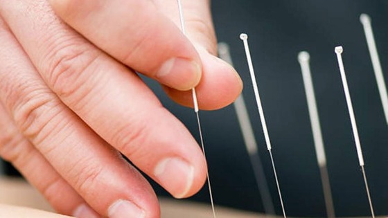 Close-up of a hand carefully holding a thin acupuncture needle among several others standing upright on a dark surface.
