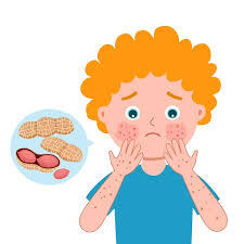 Allergy